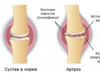 Наколенники при артрозе коленного сустава: как выбрать оптимальный вариант Наколенники для лечения артроза коленного сустава